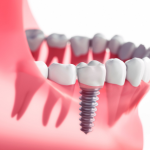 Single tooth Implant